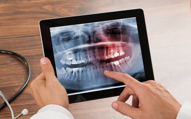 A person holding a tablet with an x - ray image of a tooth.