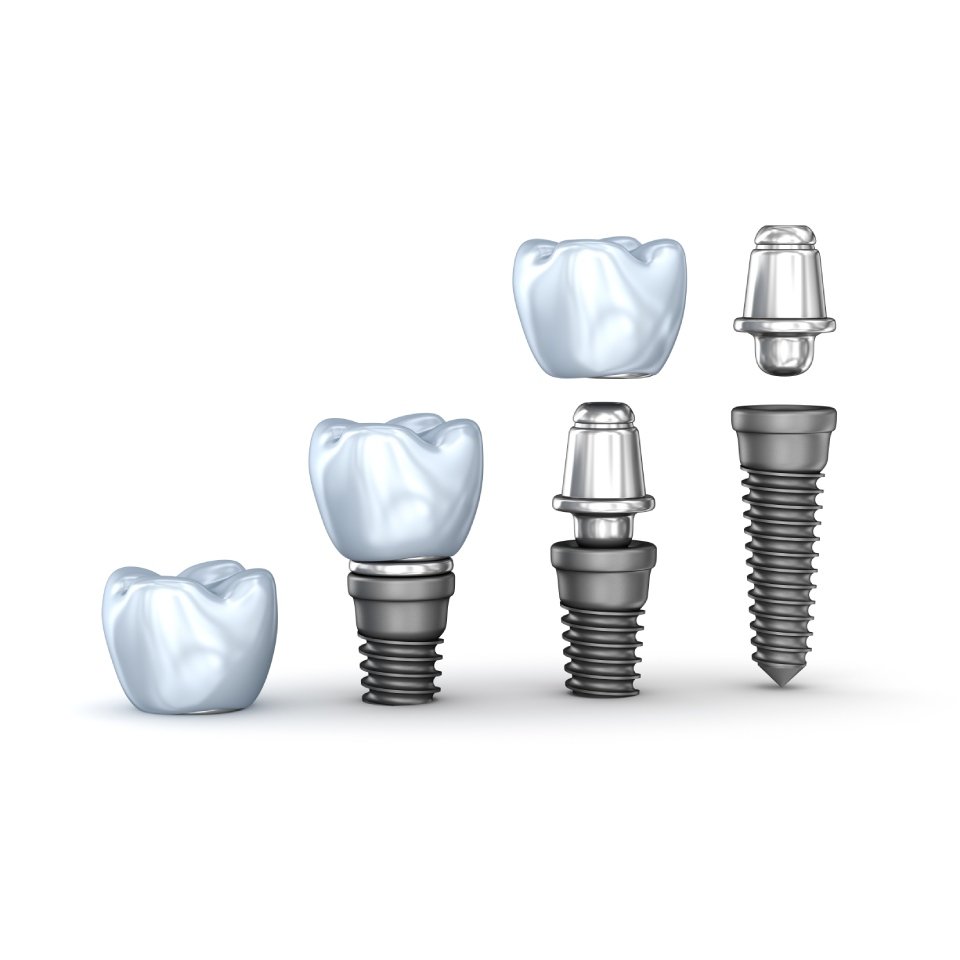 Set of dental implants isolated on white background 3D illustration