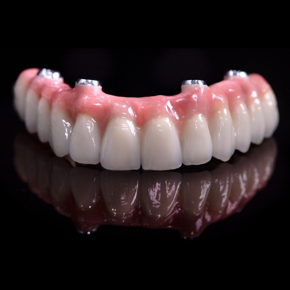 Upper zirconia full arch prosthesis with white teeth and pink anterior gums on dental implants