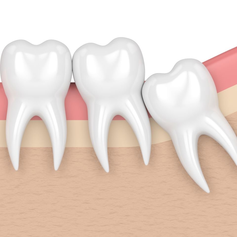 Illustration of three molar teeth, with the third tooth emerging at an angle, partially impacted in the gum.